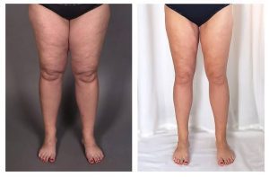 celebrities lipedema, liposuction