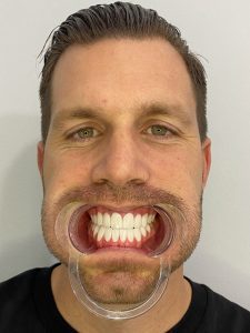 Nicolas, Cades Clinic, Istanbul, Smile Makeover, Zirconia Crown, dental treatment