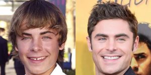 Zac Efron, Hollywood smile, smile makeover, istanbul, cades clinic