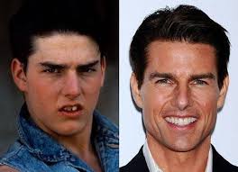 Tom Cruise, Hollywood smile, smile makeover, istanbul, cades clinic