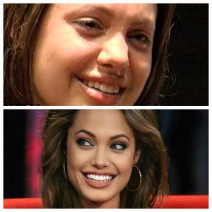 Angelina Jolie, Hollywood smile, smile makeover, istanbul, cades clinic