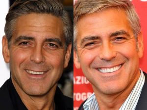 George Clooney, Hollywood smile, smile makeover, istanbul, cades clinic