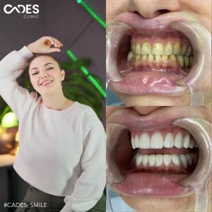 Julia, Cades Clinic, Dental Treatment, Zirconia Crown, Veneer