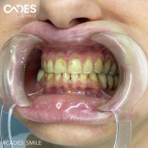 Julia, Cades Clinic, Dental Treatment, Zirconia Crown, Veneer