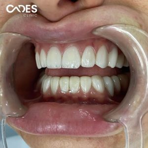 Julia, Cades Clinic, Dental Treatment, Zirconia Crown, Veneer