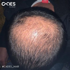 Bilal, hair transplant, istanbul, cades clinic