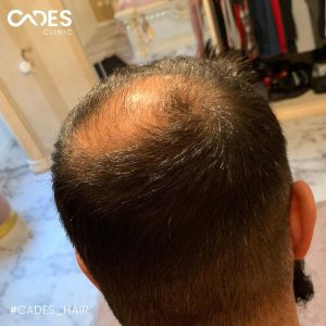 Bilal, hair transplant, istanbul, cades clinic