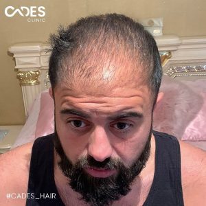 Bilal, hair transplant, istanbul, cades clinic