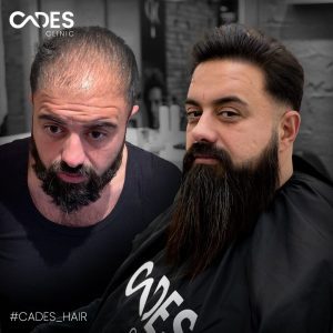 Bilal, hair transplant, istanbul, cades clinic