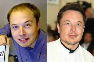 Elon Musk, Plastic Surgery, Hair Transplant, Rhinoplasty, Istanbul