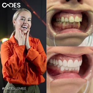 Melanie, hollywood smile, dental treatment, istandbul, cades clinic