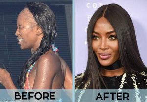 Naomi Campbell, hair transplant