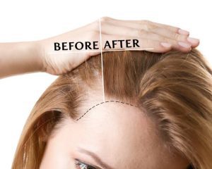 female hair transplant